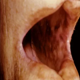 Przebarwienia w jamie ustnej