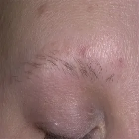 Przerzedzenie brwi łysienie plackowate