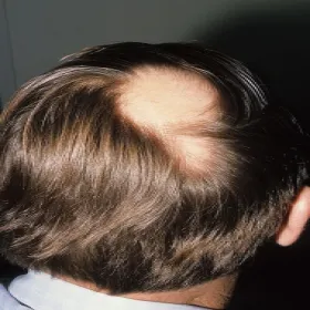 Przerzedzenie włosów na czubku głowy