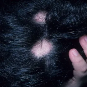 Przerzedzone włosy na przedziałku