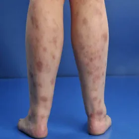 Przyłuszczyca na nogach