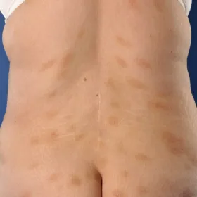 Przyłuszczyca na plecach