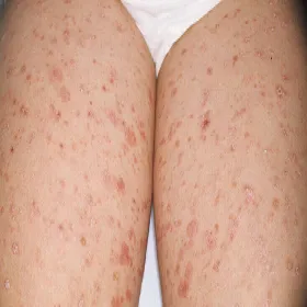 Przyłuszczyca na udach