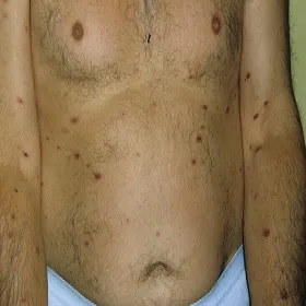 Przyłuszczyca objawy