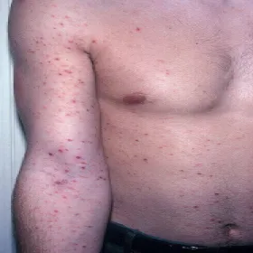 Przyłuszczyca plackowata drobnoogniskowa 