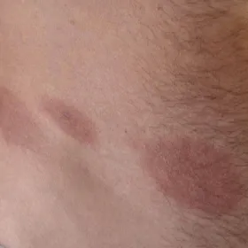 Przyłuszczyca plackowata wieloogniskowa 