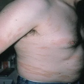 Przyłuszczyca u mężczyzny