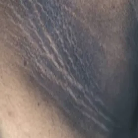 Przyciemniona skóra w pachwinie choroba rogowacenie ciemne