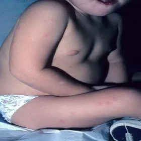 Pseudomonas aeruginosa zapalenie włosków mieszkowych u dziecka