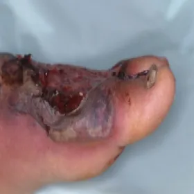 Pyoderma gangrenosum