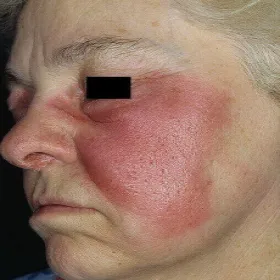 Róża choroba na twarzy