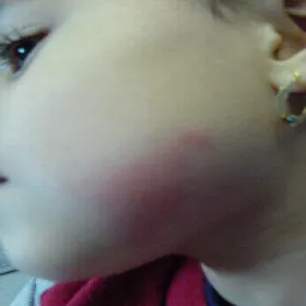 Róża choroba u dziecka