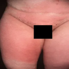 Róża choroba w miejscu intymnym