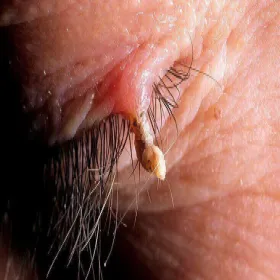 Róg skórny na powiece