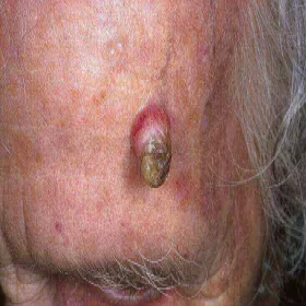 Róg skórny zdjęcie