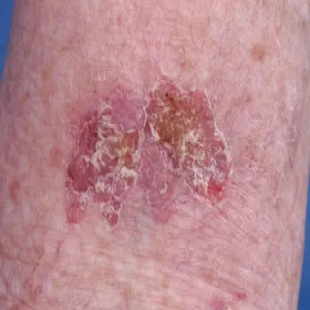 Rak kolczystokomórkowy śródnaskórkowy choroba Bowena