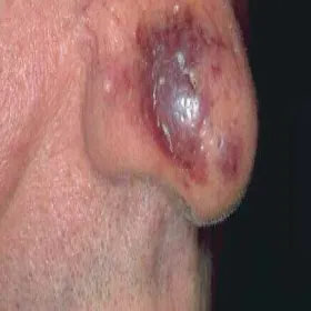 Rak nosa mięsak Kaposiego 