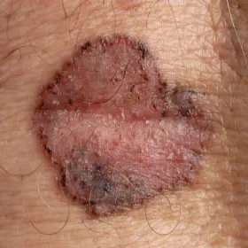 Rak podstawnokomórkowy barwnikowy zdjęcia