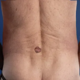 Rak podstawnokomórkowy barwnikowy