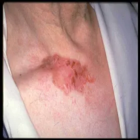 Rak podstawnokomórkowy powierzchowny