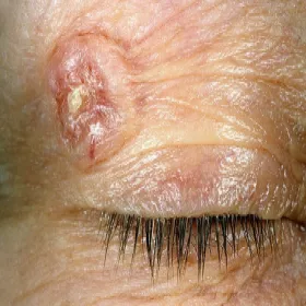 Rak podstawnokomórkowy skóry powiek