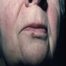 Rak podstawnokomórkowy skóry ust