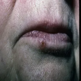 Rak podstawnokomórkowy skóry wargi