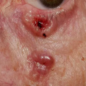 Rak podstawnokomórkowy wrzodziejący