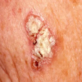 Rak skóry choroba Bowena