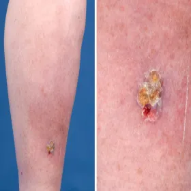 Rak skóry na nodze choroba Bowena