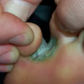 Rana między palcami u nóg stopa sportowca 