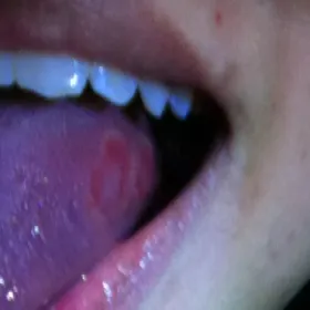 Rana na języku od ugryzienia 