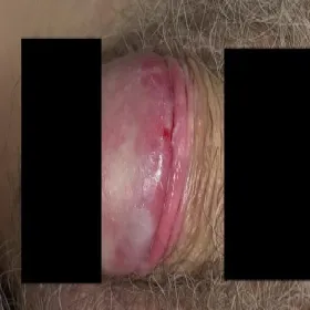 Rany na napletku zapalenie napletka