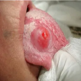 Rany w jamie ustnej po ugryzieniu