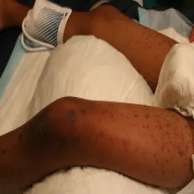 Reakcja alergiczna na leki zespół Stevensa- Johnsona