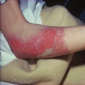 Reakcja na leki  toksyczna nekroliza naskórka