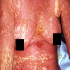 Reakcja na leki sterydowe toksyczna nekroliza naskórka