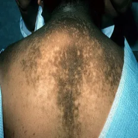 Rogowacenie ciemne na plecach