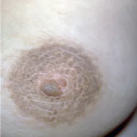 Rogowacenie ciemne piersi