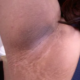 Rogowacenie ciemne pod pachami