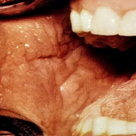 Rogowacenie ciemne w jamie ustnej