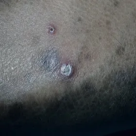 Rogowacenie mieszkowe choroba Kyrla