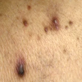 Rogowacenie mieszkowe i okołomieszkowe choroba Kyrle