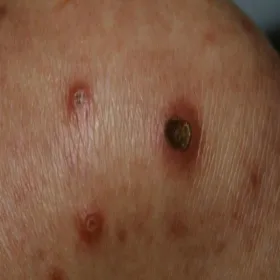 Rogowacenie mieszkowe i okołomieszkowe wnikające do skóry choroba Kyrle