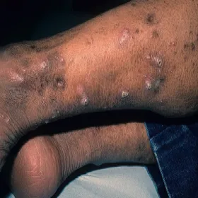 Rogowacenie mieszkowe i okołomieszkowe wnikające do skóry