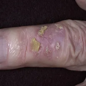 Rogowacenie słoneczne na palcu