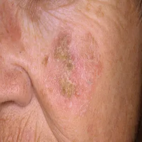 Rogowacenie słoneczne na poliku