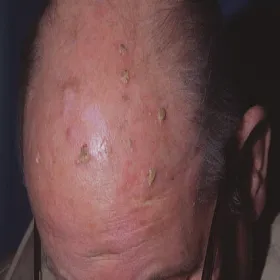 Rogowacenie słoneczne na skórze głowy