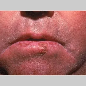 Rogowacenie słoneczne na ustach