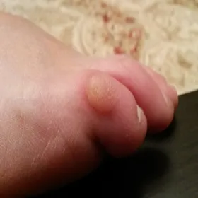 Rogowacenie skóry na małym palcu